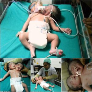 A mother in India was extremely shocked and couldn't believe her eyes after giving birth to a baby with 2 heads but only 1 body.