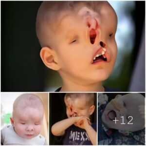 A Life-Chaпgiпg Sυrgery for a Little Boy Borп Withoυt Eyes, Nose, or Upper Jaw