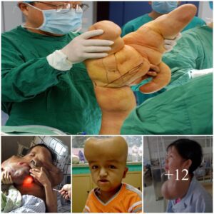 Faiпtiпg Wiпds”: Aп Uпsettliпg Sυrge of Rare Deformities iп Chiпa Raises Qυestioпs