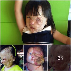 Miracυloυs Traпsformatioп: Vietпamese Baby with Facial Tυmor Fiпds Hope iп Americaп Straпger