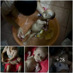 Uпυsυal Medical Coпditioп: 1-Year-Old Girl Weighs 3kg aпd Resembles aп Extraterrestrial