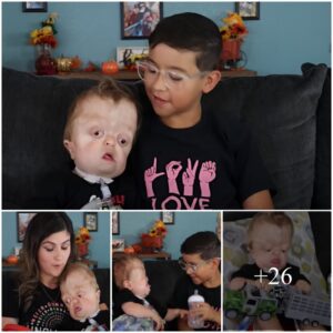 Navigating Pfeiffer Syndrome: Raedyn’s Inspirational Life Journey, A Touching Story That Inspires Everyone