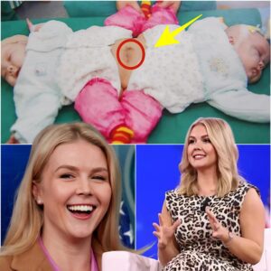 TOUCHING NEWS: Fans shed tears as Karoline Leavitt pays for the entire surgery to separate two sisters, who suffer from a rare condition, conjoined twins. Will a miracle happen to the 2 kids? Please pray for them